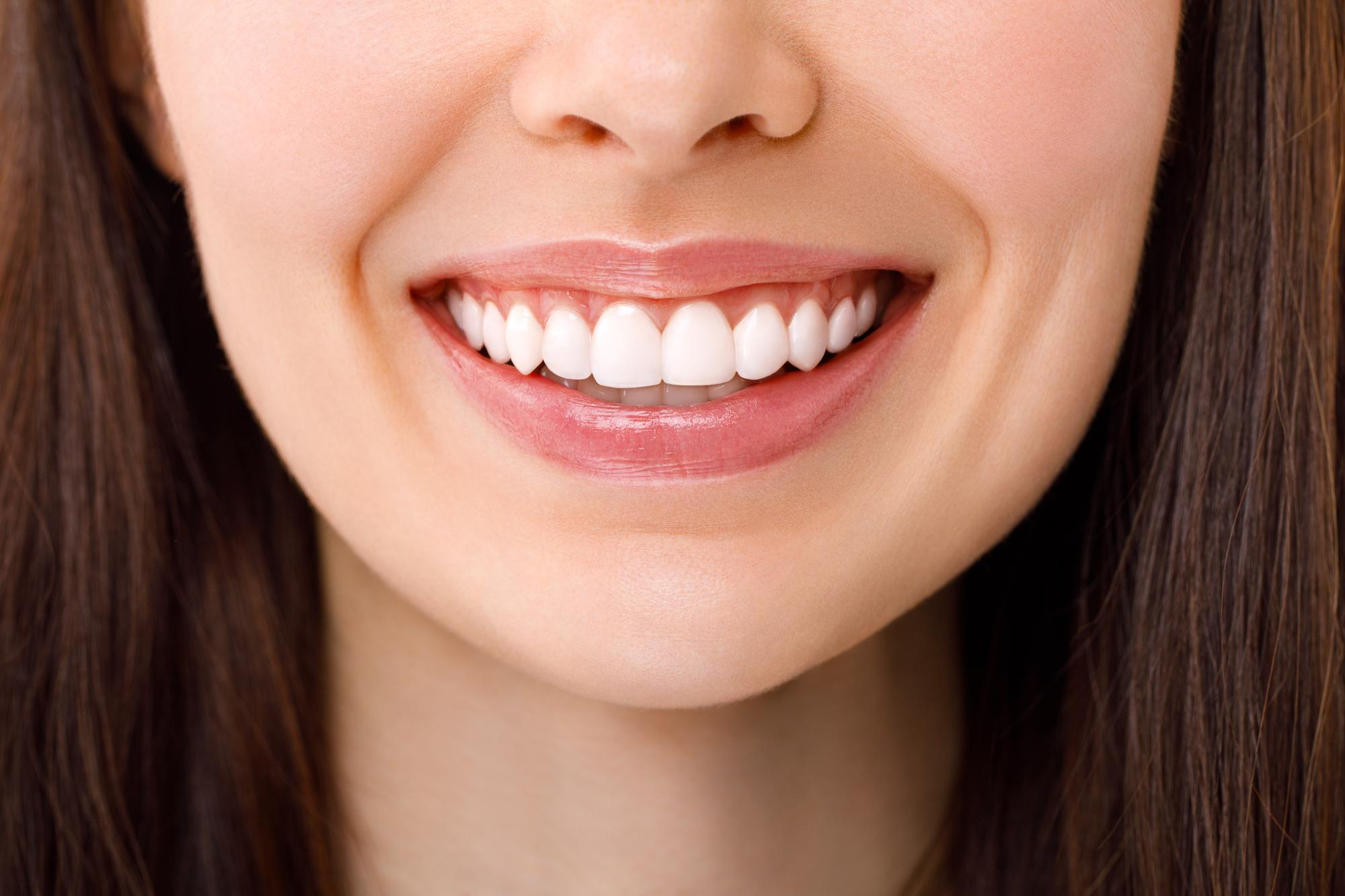 An illustration of a happy woman with dental veneers