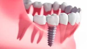 single-dental-implant-in-the-jaw