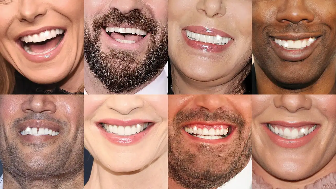 26 Celebrity Dental Implants and Veneers Before and After Photos