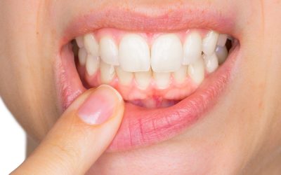 Diş Eti Bakımı Nasıl Yapılmalıdır