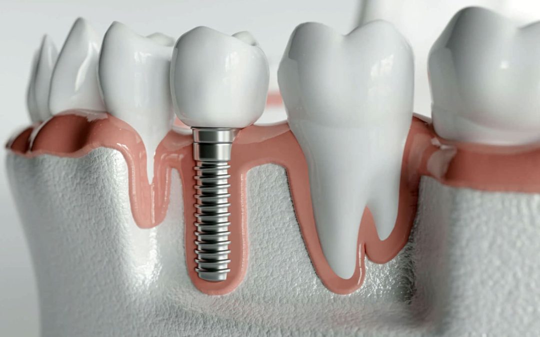 Diş İmplantı Tedavisi Nedir ve Nasıl Uygulanır?