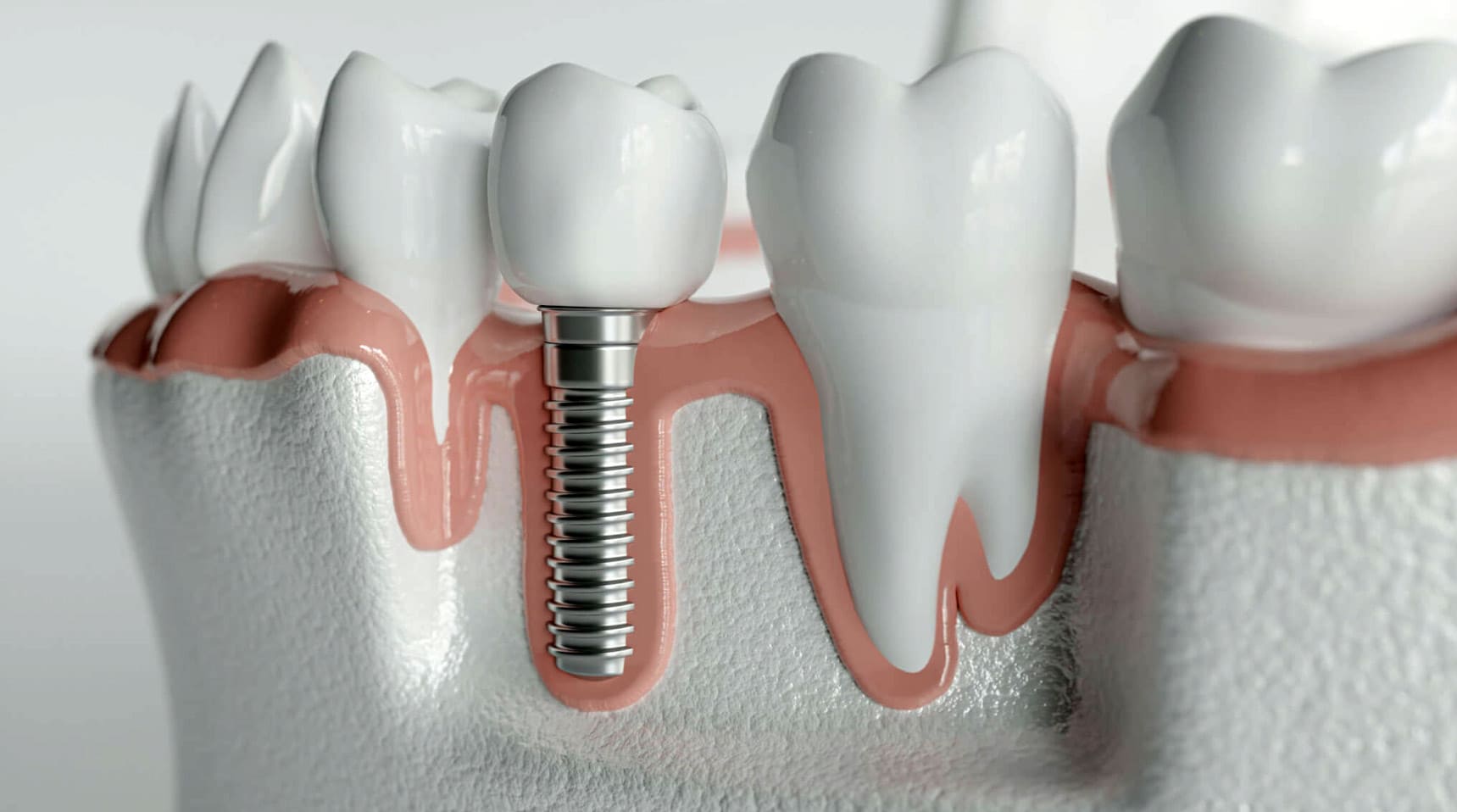 Diş İmplantı Tedavisi Nedir