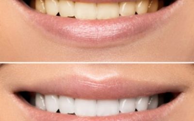Diş Beyazlatma Nedir ve Nasil Uygulanır?