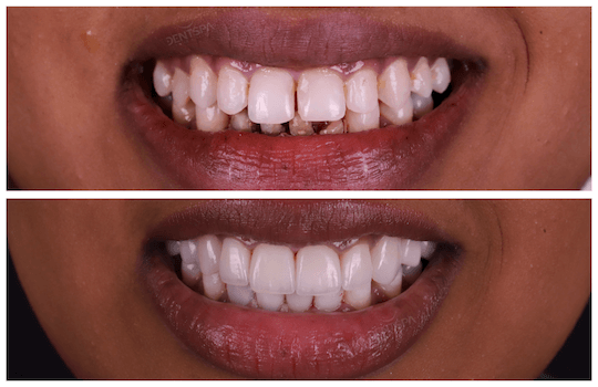 Dişlere Bonding Uygulaması Ne Zaman Yapılır?