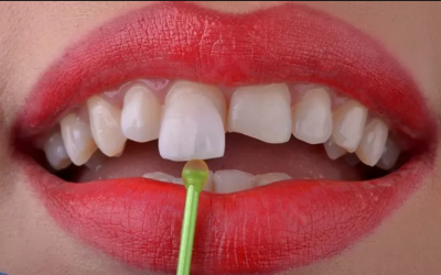 Lamine Diş Tedavisi Nedir?