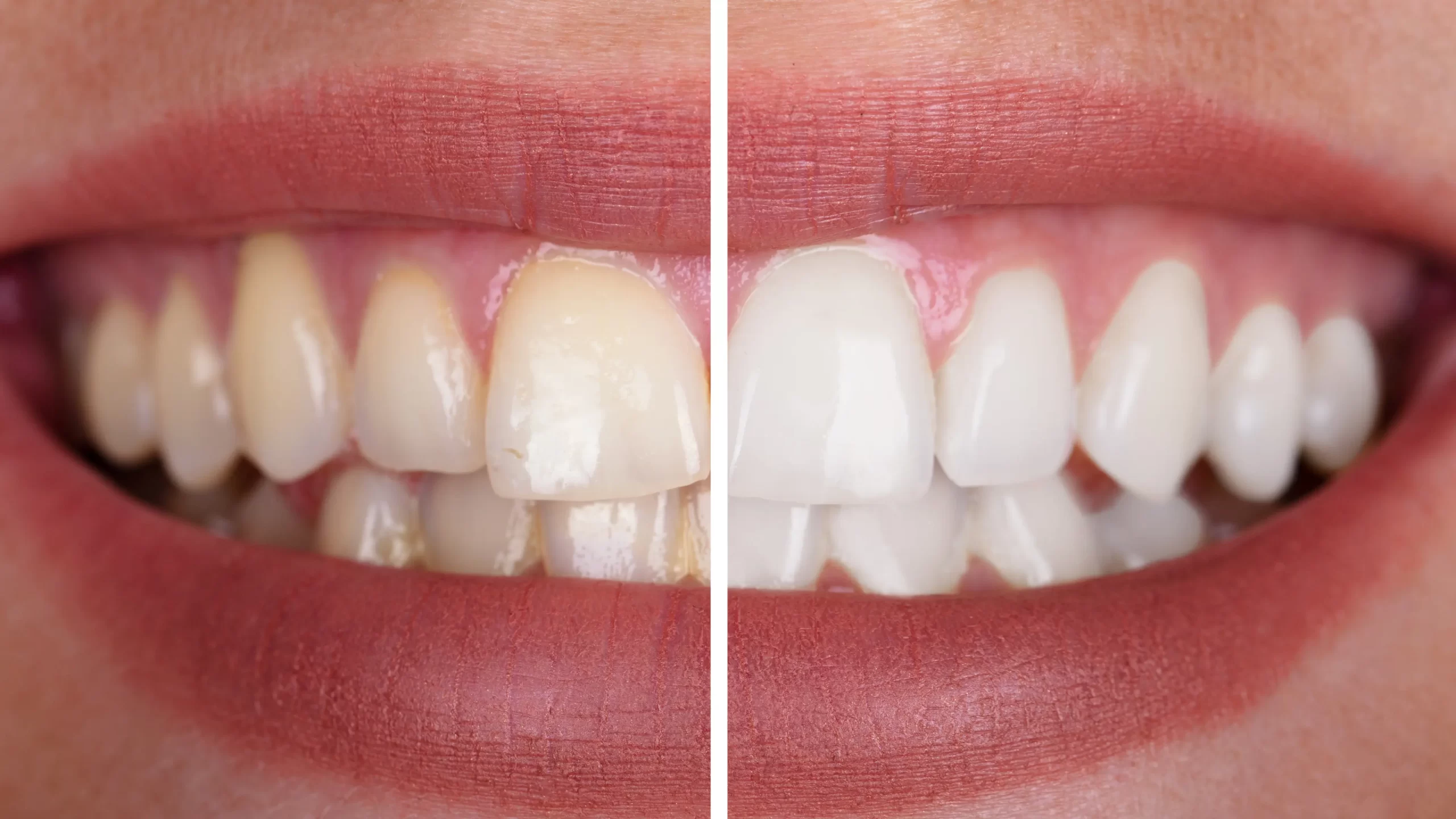 diş beyazlatma öncesi ve sonrası